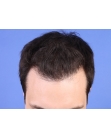 After Hair Transplant&nbsp;Front